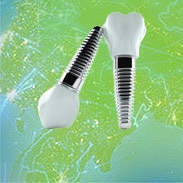 Dental Implants Image